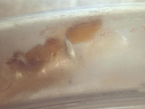 Unknown contamination in a feeding tube.